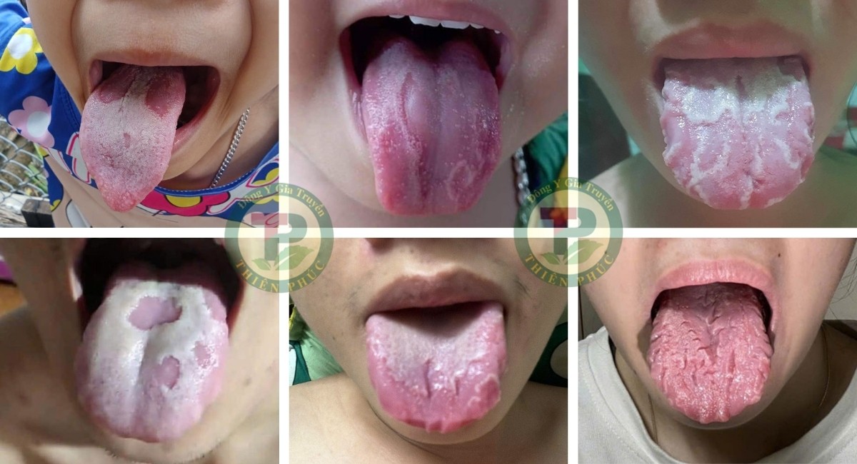 Những hình dạng nấm lưỡi bản đồ thường gặp.